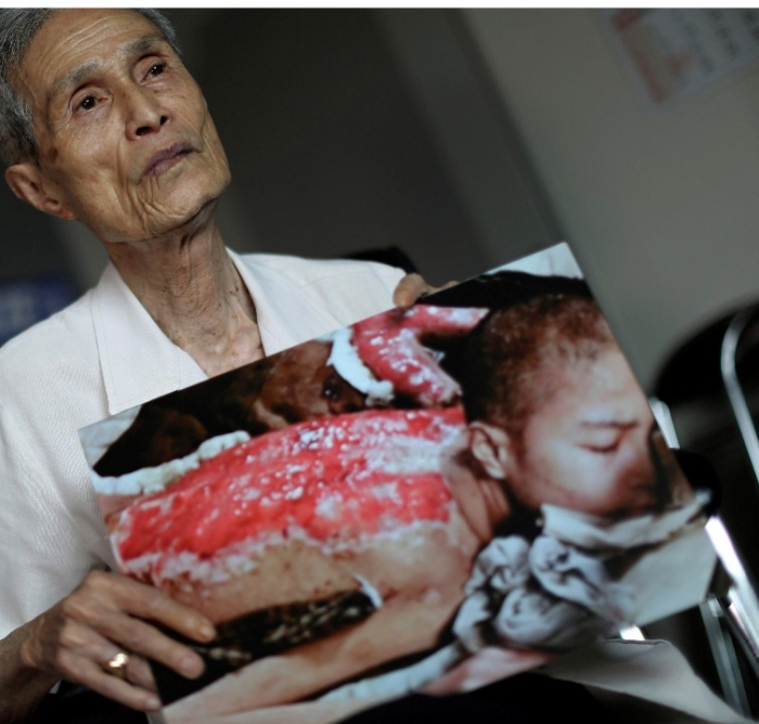 En overlevende fra Nagasakibomba. AP Photo/Eugene Hoshiko, File
